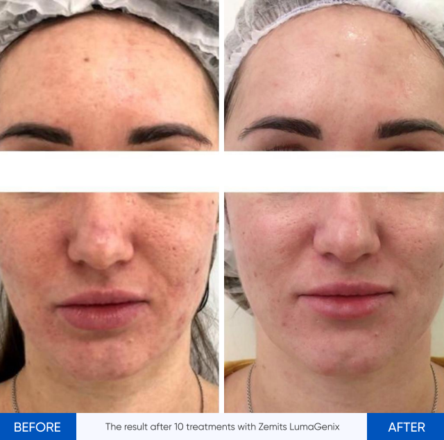 Zemits LumaGenix PDT Professionelles LED-Lichttherapiegerät