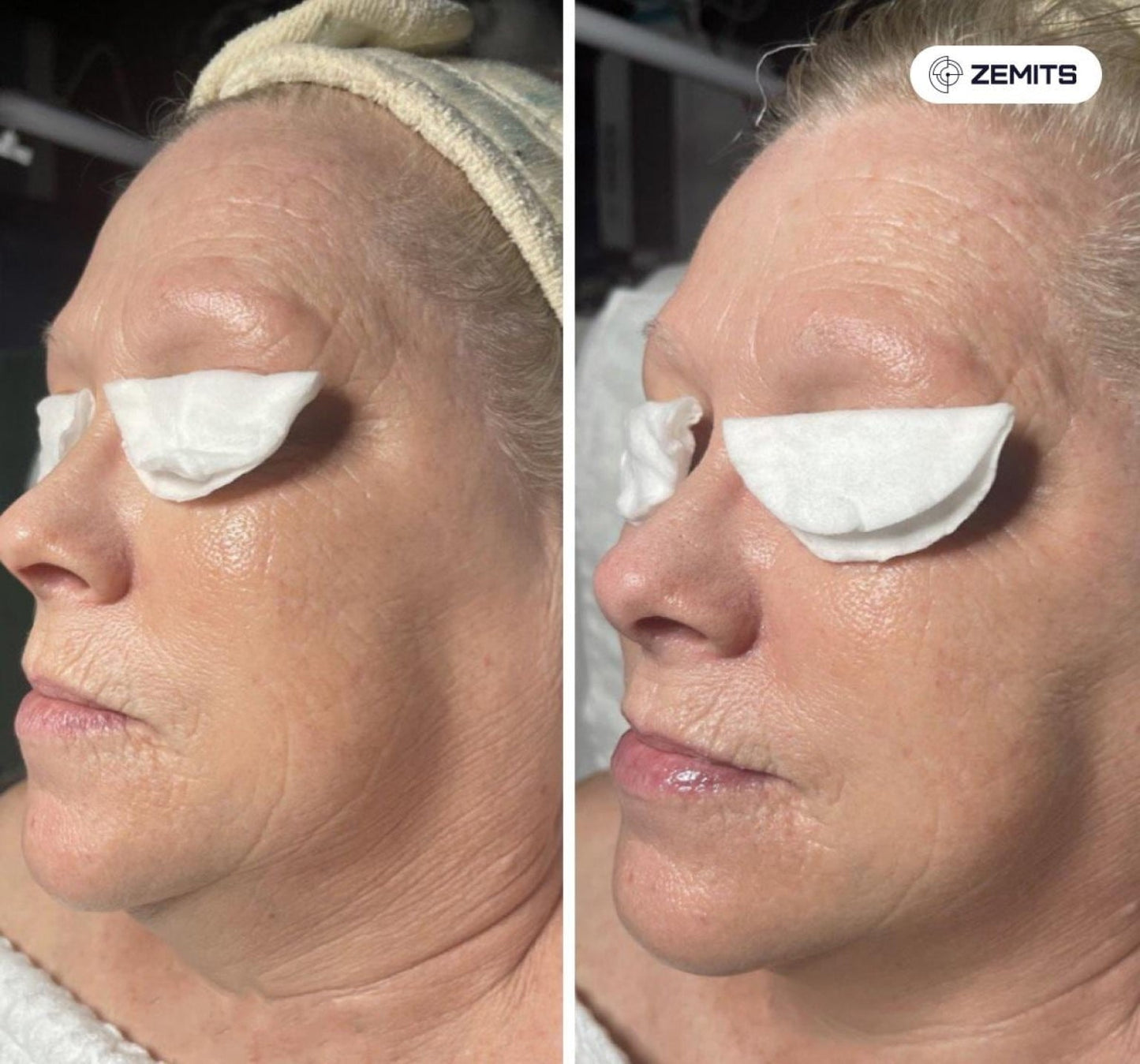 Zemits Klein EL Elektroporationssystem