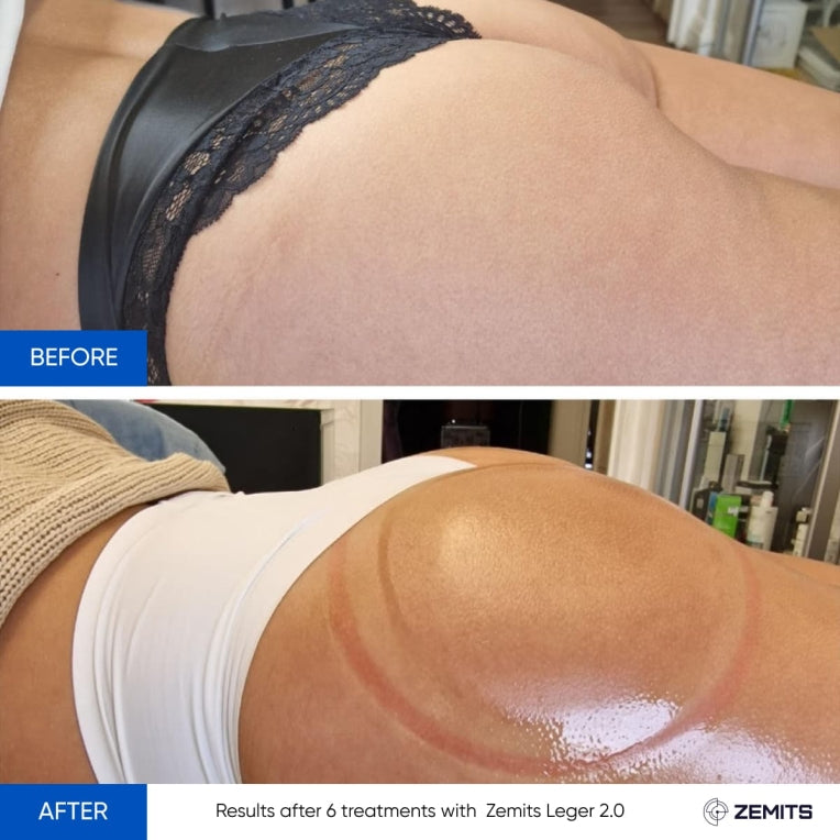 Zemits Leger 2.0 Vakuum-Kuppelsystem mit XXL-Bechern im Set