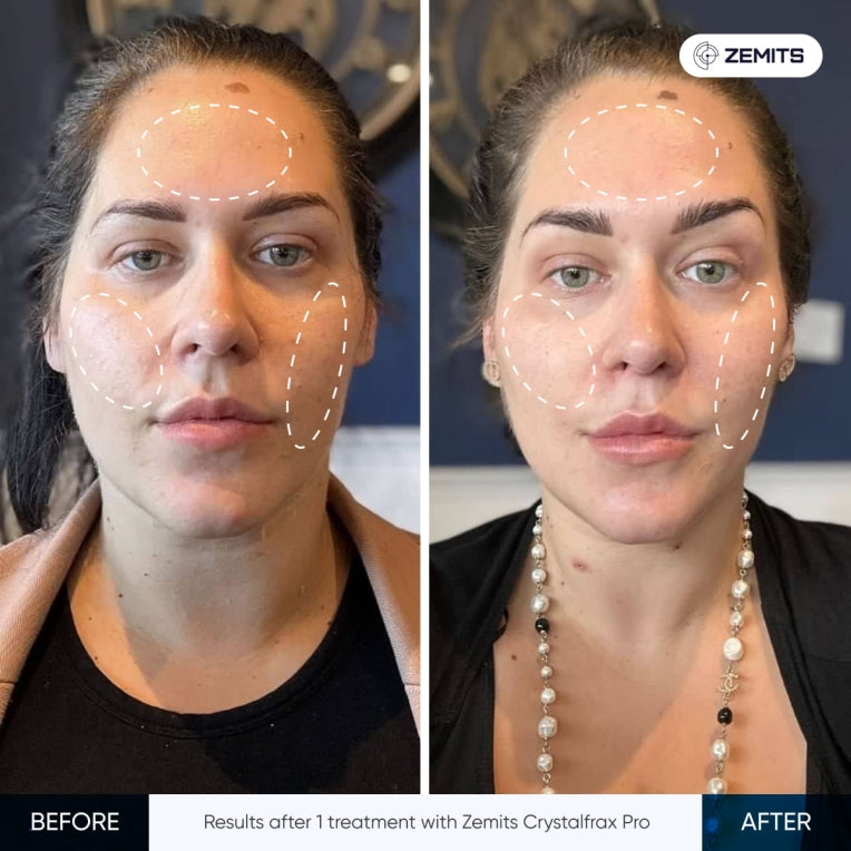 Zemits CrystalFrax PRO Nicht-invasives fraktioniertes RF-System